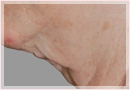 Exilis Skin Tightening Treatment New Orleans - Fine Lines, Wrinkles & Folds Case 13